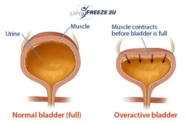 diagram of overactive bladder treatment Melksham