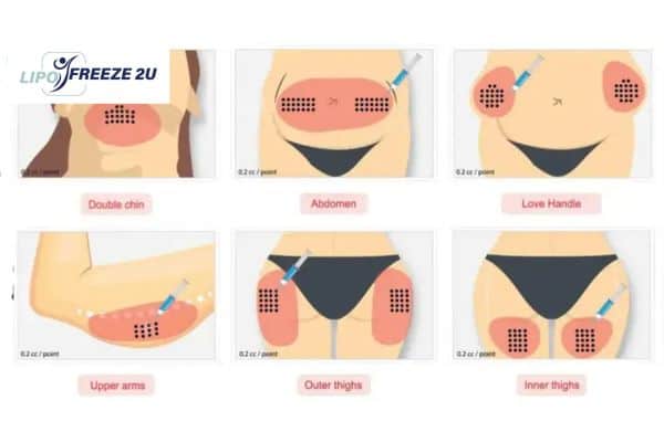 Aqualyx Fat Dissolving Injections 1