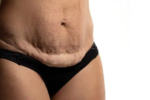 loose skin after weight loss injections Melksham