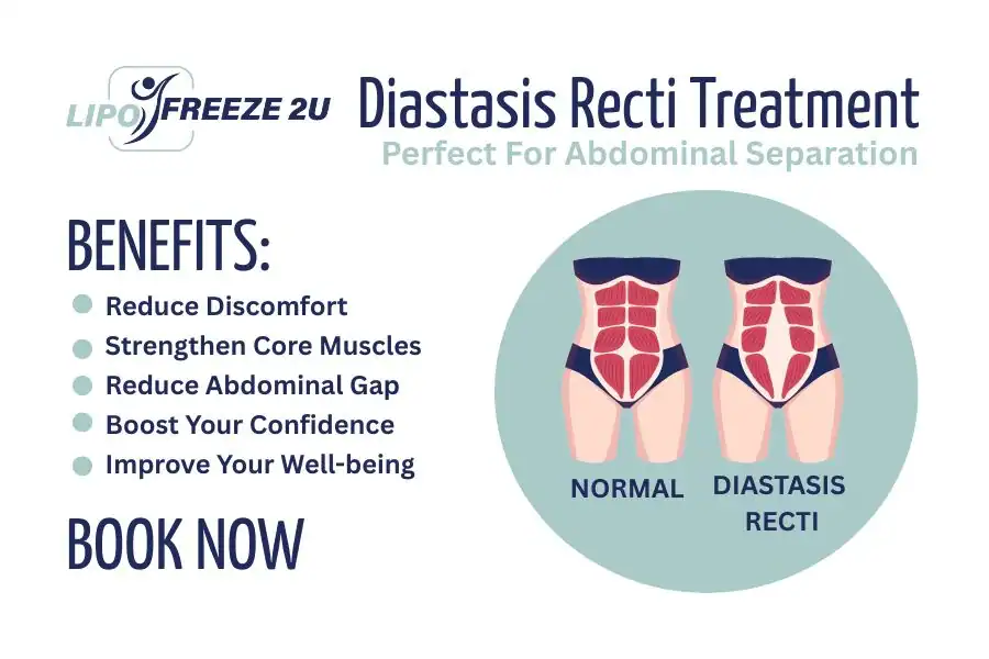 Benefits of body toning treatment Melksham for Diastasis recti