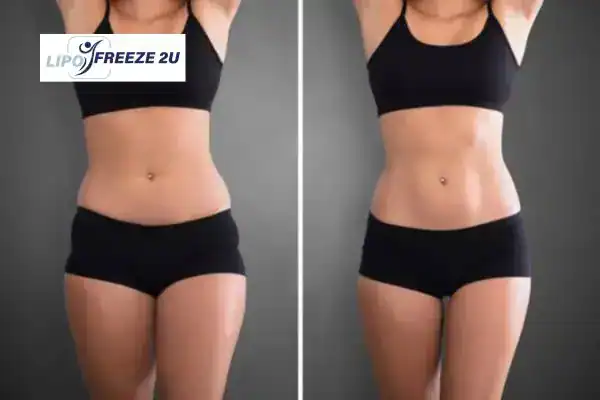 How Can LIPO FREEZE 2U Support Your Post-Pregnancy Body Recovery Melksham?