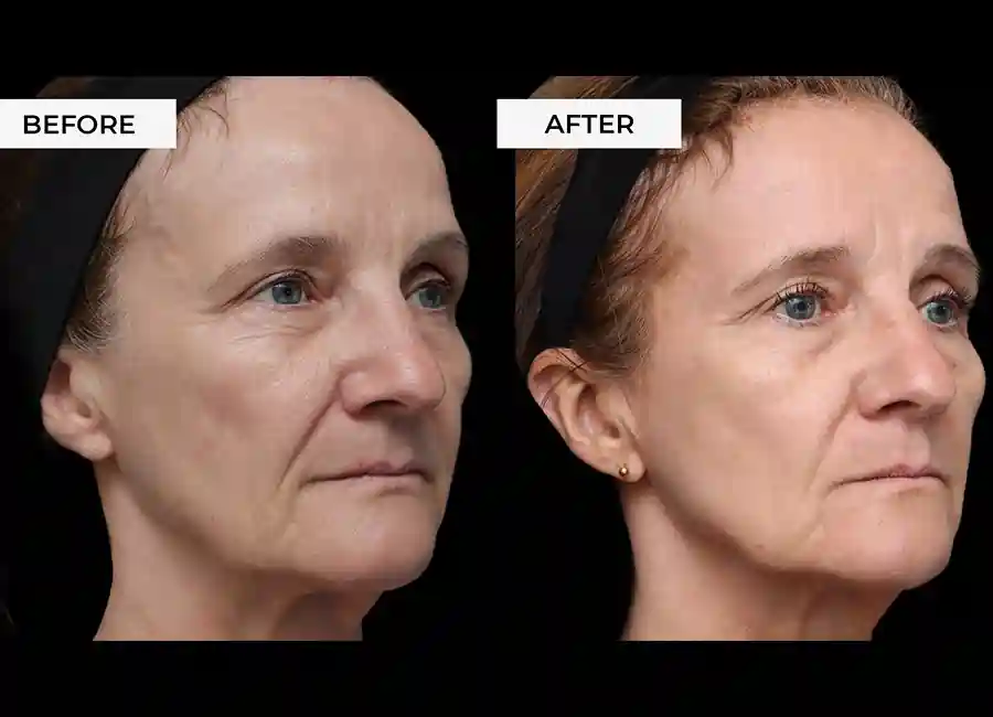 How Many RF Microneedling Sessions Will You Need to See a Difference Melksham?