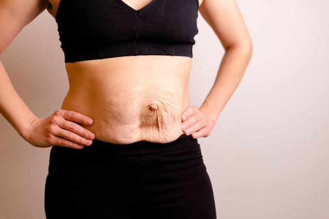 Is Surgery Really the Only Way to Repair Diastasis Recti Melksham?