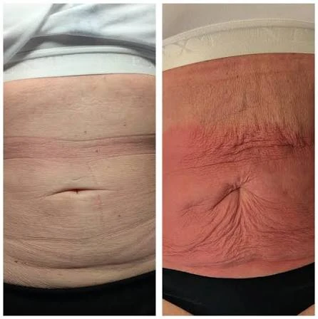 How Does RF Microneedling Improve Crepey, Thin and Uneven Skin Texture Melksham?