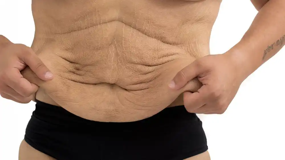 RF Microneedling for Loose Skin: How Can It Help Tighten and Reshape the Skin Melksham?